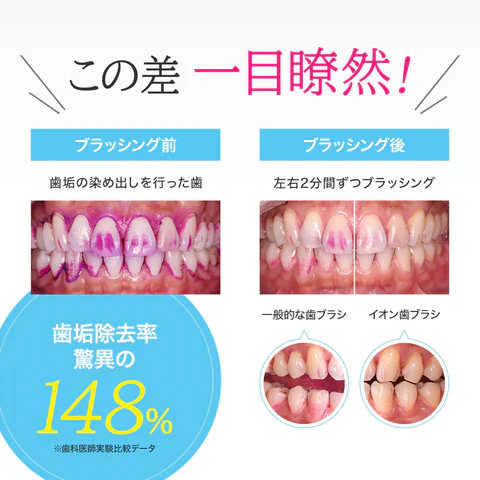 Hukuba Dental Ионная зубная щетка отбеливающая KISS YOU Ionic Beauty (1 шт) - JapanTrading